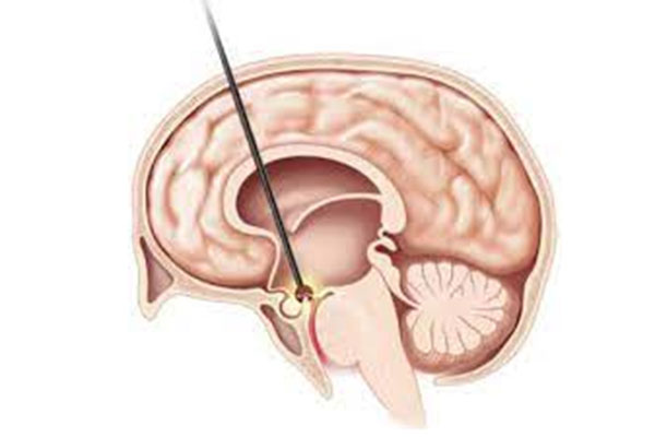Χειρουργική αντιμετώπιση της Υδροκεφαλίας