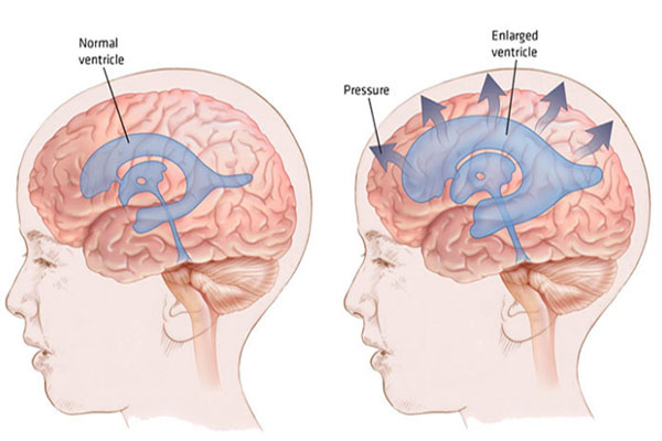 Υδροκεφαλία